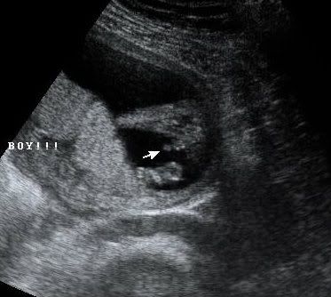Anyone Had One Like This And Found Out Girl Later Or Did Those Of You Who Experienced This Have A More Ambiguous Early Ultrasound Photobucket Anyone Had One Like This And Found Out Girl Later Or Did Those Of You Who Experienced This Have A More Ambiguous Early Ultrasound Photobucket