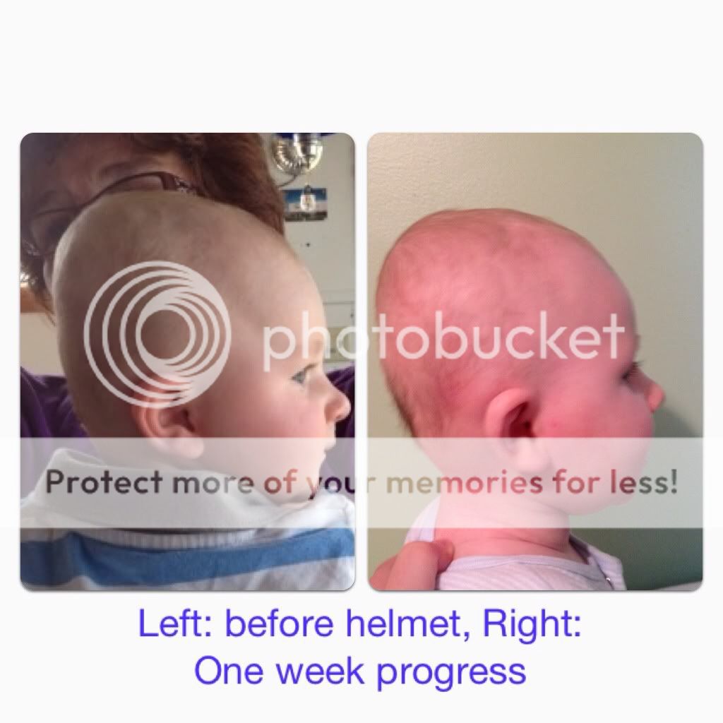 Anybody's LO have flathead and have to wear a helmet? BabyCenter